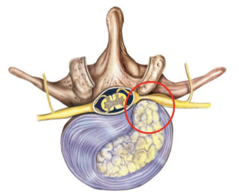 <p>Nucleus pulposus herniates (protrudes) into vertebral canal due to tear or rupture in the annulus fibrosis</p>