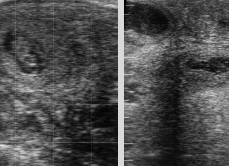 <p>palpation and U/S</p><p>-no fetus</p><p>-no placentomes</p><p>-visualize flocculant material</p>