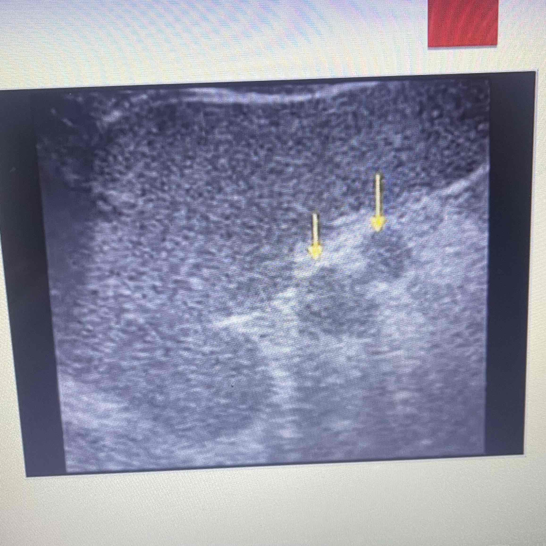 <ul><li><p>AKA splenule</p></li><li><p>Collection of normal splenic tissue separate from the spleen</p></li><li><p>Common congenital, anomaly, 30% of population</p></li><li><p>Clinically; Asymptomatic, palpable lump depending on size/location</p></li><li><p>Sonographic: Homogeneous, isoechoic to Spleen near hilum or superior border</p></li></ul>