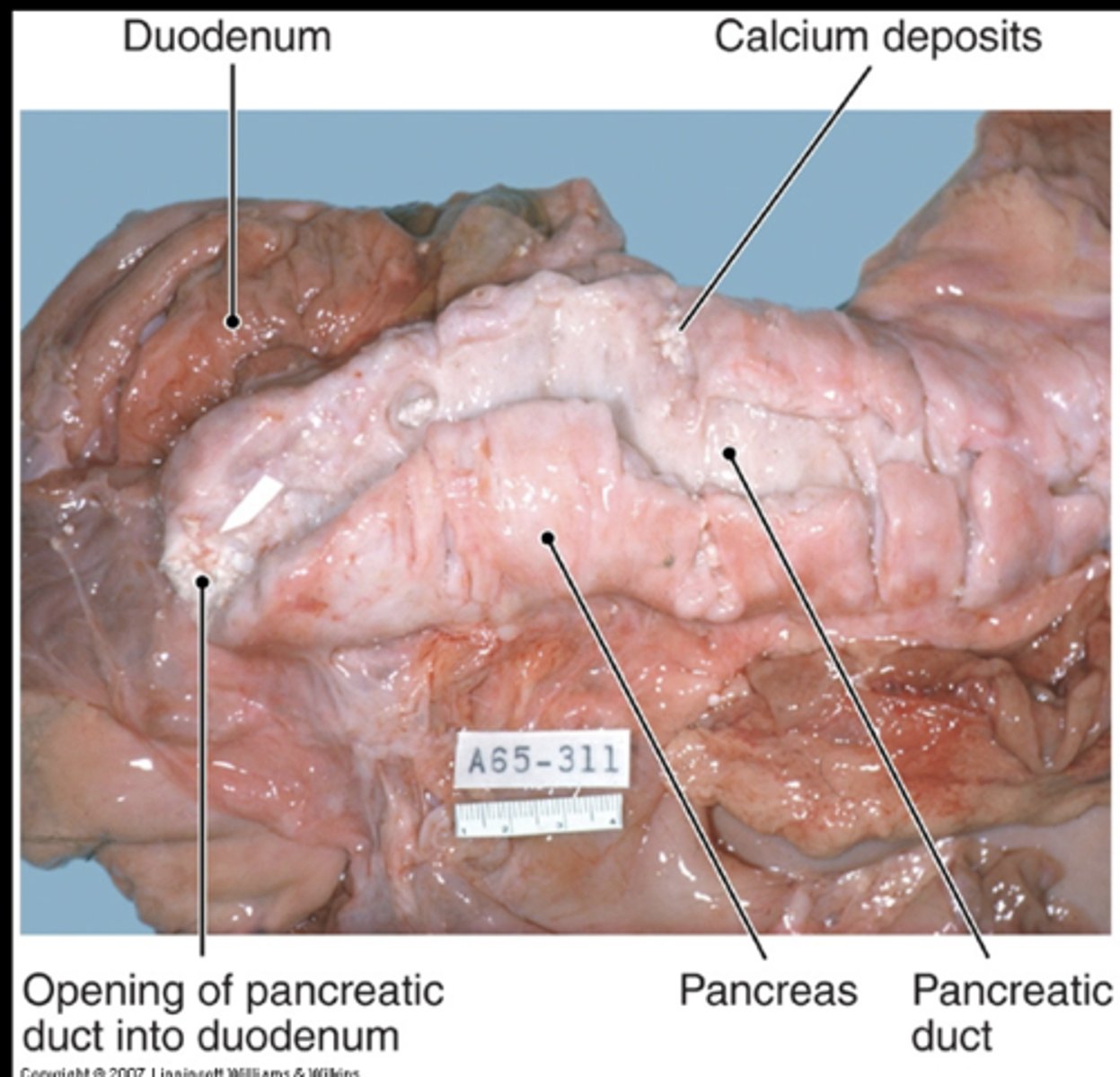 <p>About 2/3 of cases due to chronic alcoholism, the remainder usually have no known cause</p><p>Gallstones are not involved</p><p>About ½ have evidence of prior acute pancreatitis</p><p>Dense scar tissue, dilated ducts, gritty calcification</p><p>Could render patient diabetic</p>