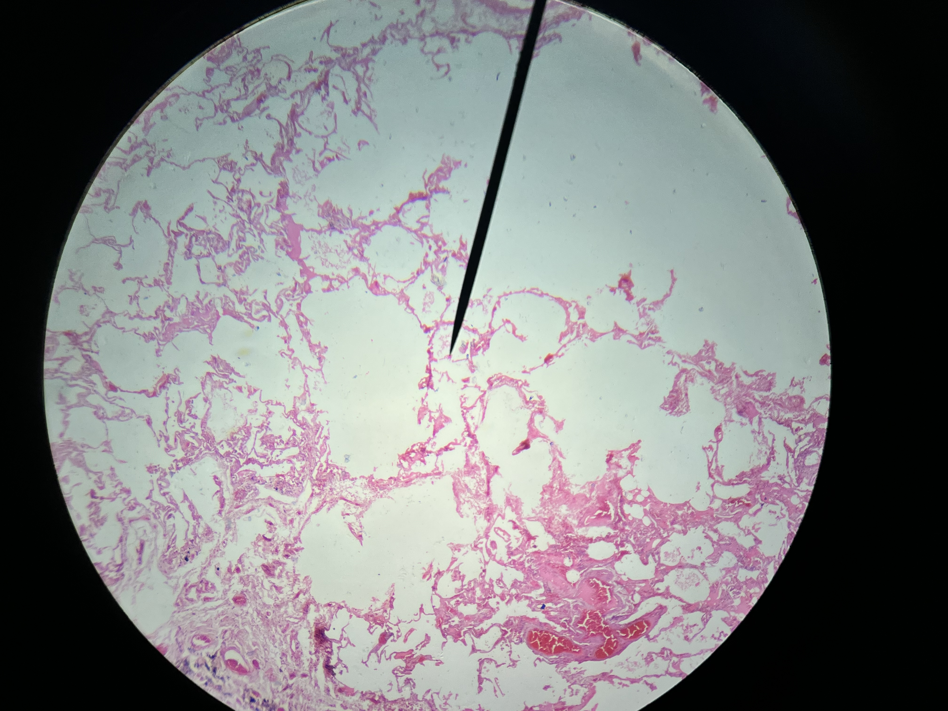 <p>A chronic lung condition characterized by the destruction of alveoli, leading to reduced elastic recoil and airflow obstruction. <span>Generally considered irreversible, as the damage to lung tissue is permanent</span></p>