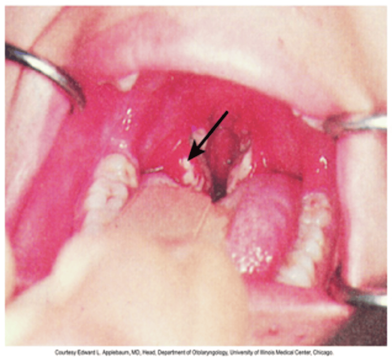 <p>- Infection of tonsils or posterior pharynx by microorganisms (Group A Beta hemolytic strep Neisseria)</p><p>- Symptoms: Sore throat, dysphagia, fever, malaise, decreased appetite</p><p>- Tonsil crypt filled with exudate, lymph node enlargement</p>