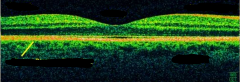 <p>Label this OCT scan</p>