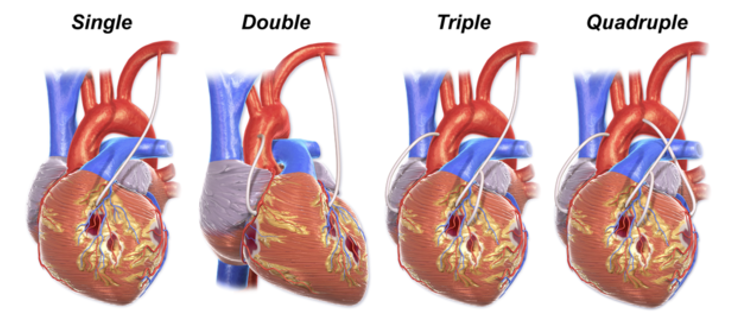 <p>When a PCI isn’t possible, blood vessels from other parts of the body can serve as conduits for blood to perfuse the heart.</p><ul><li><p>They include the internal thoracic or mammary artery (ITA or IMA), saphenous vein (SV), and radial artery (RA).</p></li></ul><p></p>