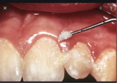 <p>Describe los 2 tipos de glucanos en el biofilm </p>