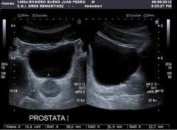 <p>Prostata:</p><ul><li><p>Está por detrás de la vejiga y <strong>es importante que la vejiga este llena para poder ver a la próstata, también debe estar llena para evaluar útero, ovarios, ecografía pélvica</strong></p></li><li><p>En <strong>ecografía transvaginal la vejiga debería estar vacía</strong></p></li></ul><p></p>