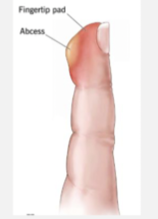 <p>A subcutaneous abscess of the the fingertip pulp that may spread from paronychia OR trauma (splinters, needlesticks)</p>