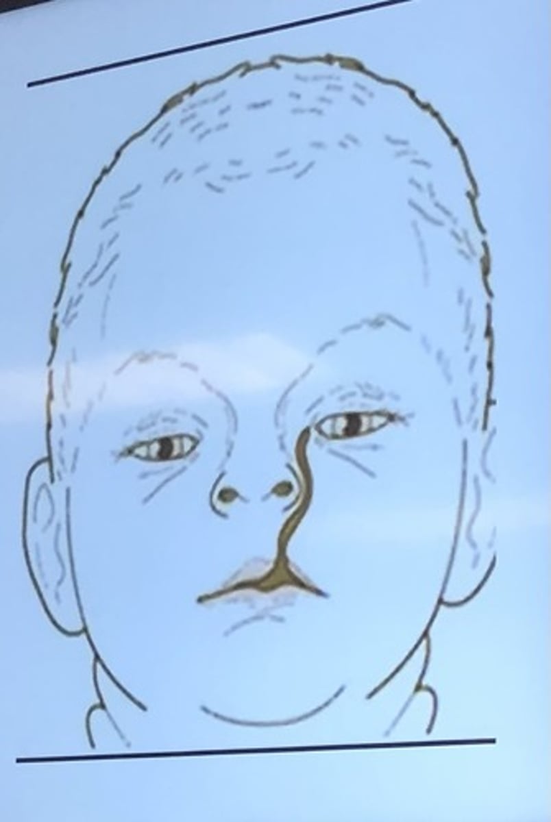 <p>Oblique facial clefts are formed by the lack of fusion of what? (2)</p>