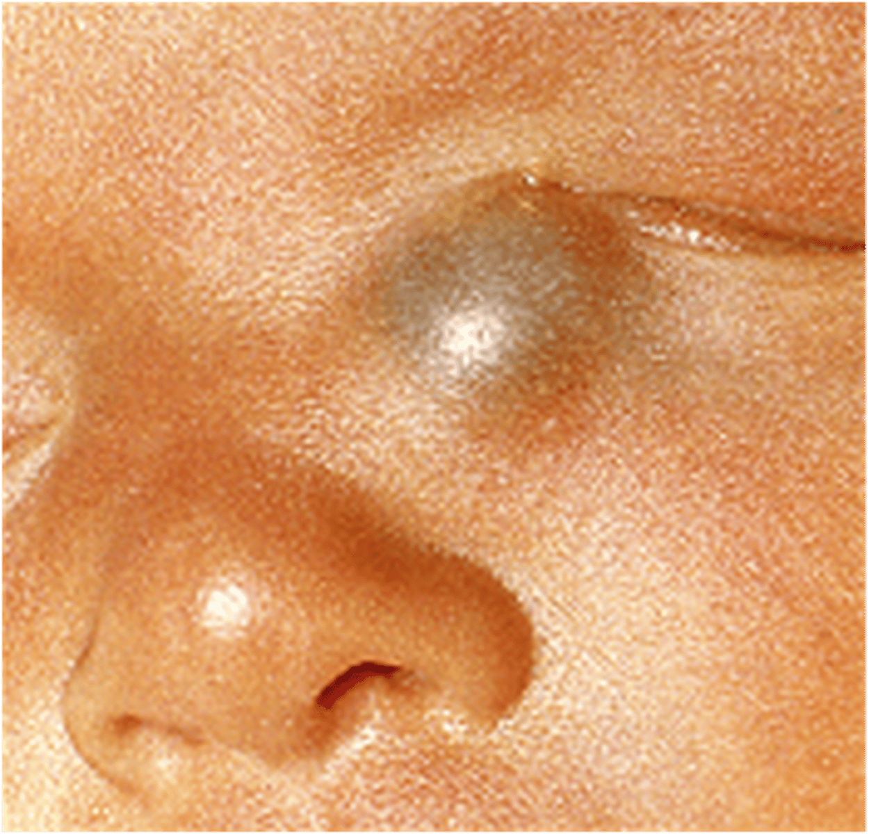 <p>Congenital Dacryocystocele</p>