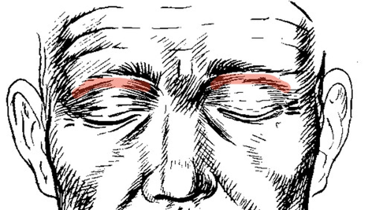 <p>wrinkles on the upper eyelid; acquired</p>
