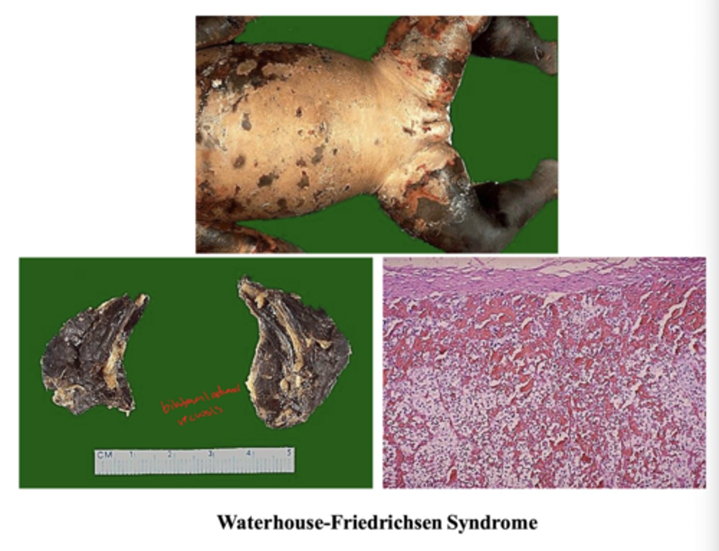 <p>Neisseria meningitidis (associated with Waterhouse-Friedrichsen Syndrome) in children</p>