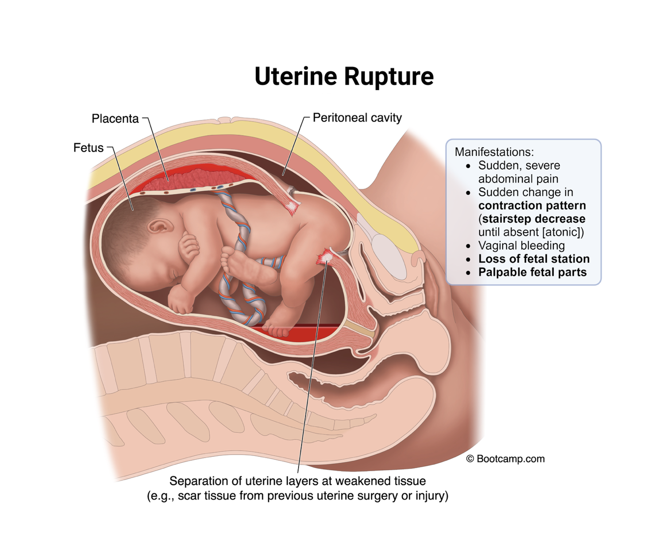 <ul><li><p>uterine layers tear</p></li><li><p>previous c section = risk for uterine rupture</p></li><li><p>abdominal pain and previous c section sugguest that client could be having a rupture </p></li></ul><p></p>