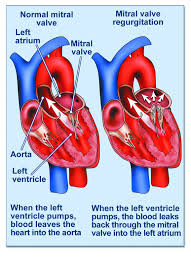 <p>Mitral Regurgitation</p>