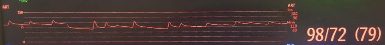 <p>-catheter sitting inside an artery (radial, femoral, brachial, &amp; pedal) </p><p>-Real time reading of B/P</p>
