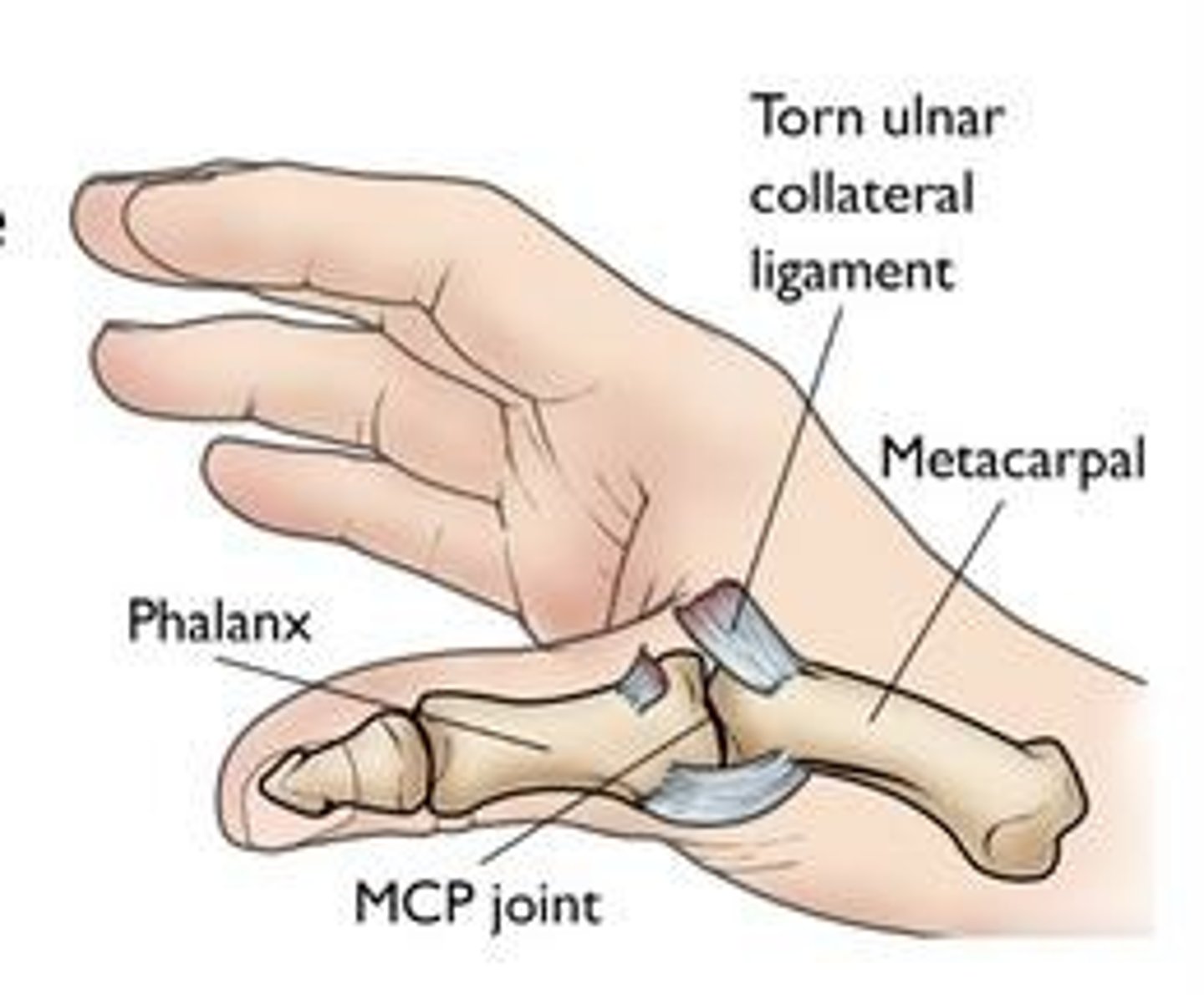 <p>Conservative treatment for grade 1-2; surgical intervention for grade 3 tears</p>