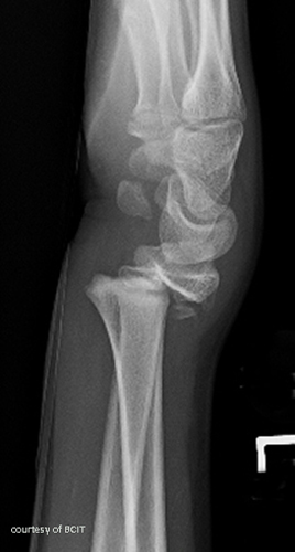 <p>What is a common result of pediatric injury mechanisms like FOOSH?</p>