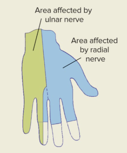 <p>when people lose all feeling and become numb in one hand</p><ul><li><p>physical damage to the ulnar nerve causes numbness in the ring and pinky fingers and up the arm</p></li><li><p>physical damage to the radial nerve causes numbness in the ring, middle, index fingers and thumb</p></li></ul><p></p>