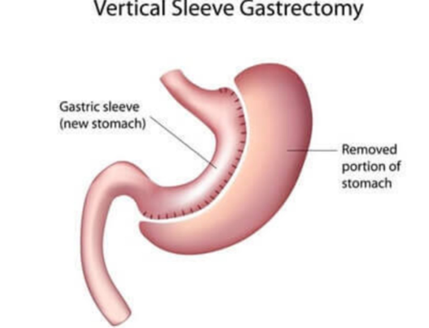<p>Part of stomach removed<br>Small stomach = less room for food (restriction)</p>