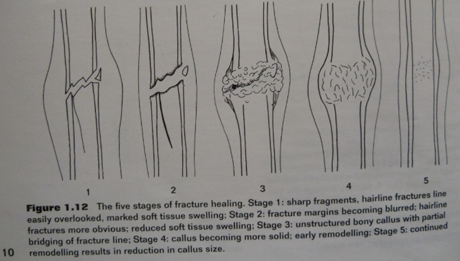 <ol><li><p>primary: when there is perfect anatomical alignment of bone ends, direct contact without callus</p></li><li><p>secondary: sharp fracture ends, fracture line blurred, unstructured bony formation, remodeling, reduction of callus. </p></li></ol><p></p>