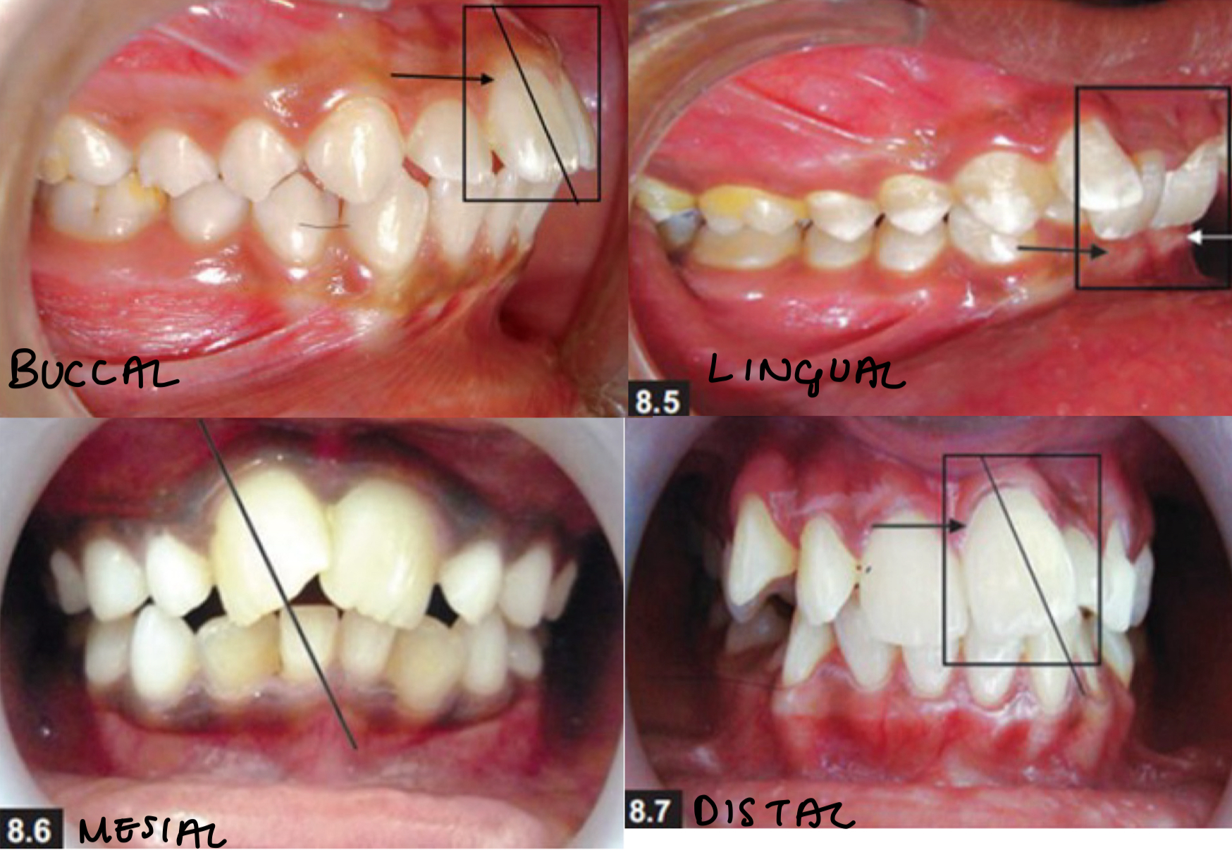 <p>Abnormal tilting of the crown, if apex in same point but tooth surface position changes </p><p>Buccal, lingual, mesial, distal </p>