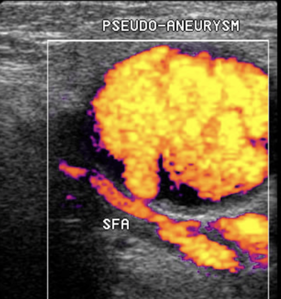 <p>Due to percutaneous arterial catheterization, penetrating trauma, or graft anastomosis "blowout"</p><p>Treated by compression, surgical repair, or thrombin injection</p>