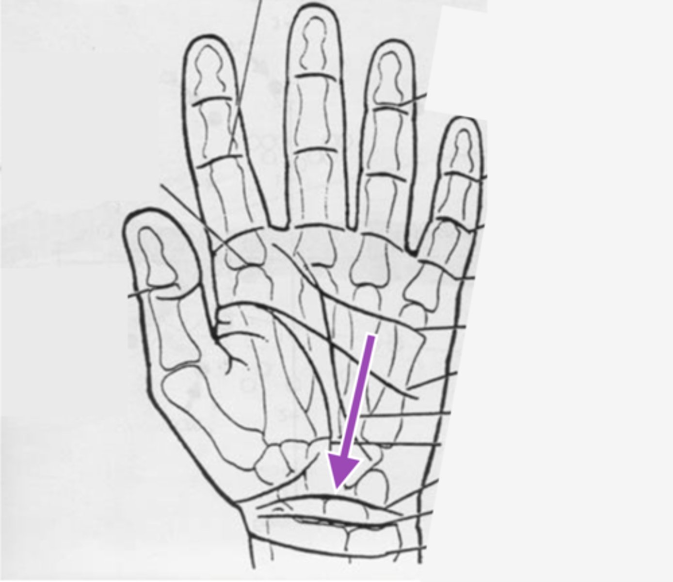 <p>crease that separates the distal and proximal rows of the carpal bones (pisiform to the tubercle of the trapezium)</p>