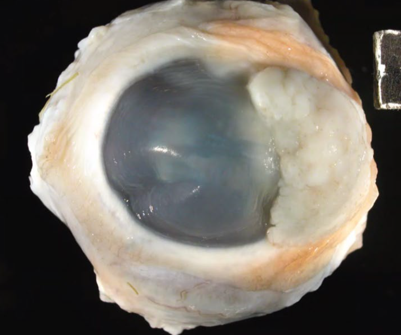 <p>What is the condition?</p><p>A-Squamous cell carcinoma</p><p>B-Melanoma</p><p>C-Adenoma</p><p>D-Schwannoma</p>