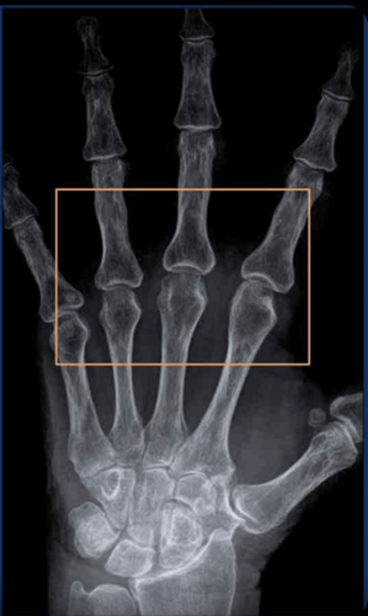 <p>LESSS: </p><p>loss of joint space, </p><p>periarticular erosions, </p><p>subluxation, </p><p>soft tissue swelling,</p><p>subarticular (periarticular) osteopenia (darkening of bones) - check pic</p>