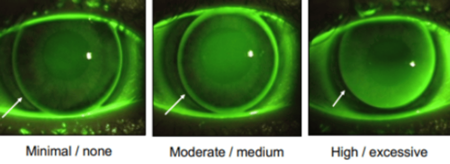 <p>GPCL pattern location which is the area under the peripheral curves. The fit in this area determines the tear exchange.</p>