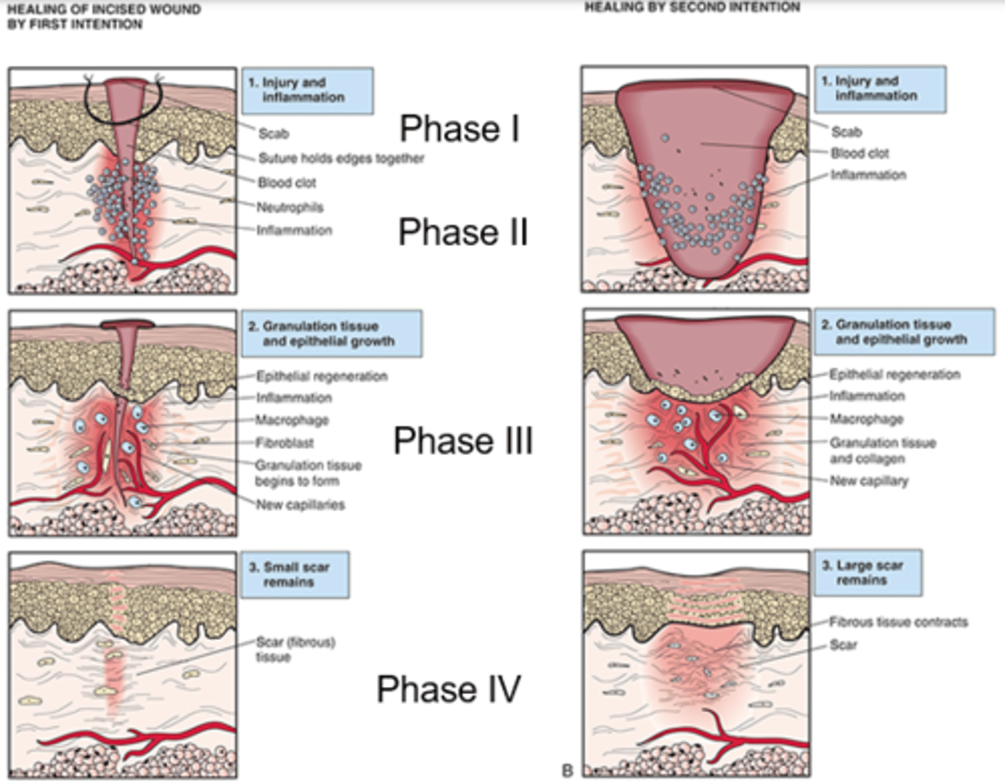 <p>- First Intention: Sealing a wound by sutures, staples, etc.</p><p>- Secondary intention: Cells fill in the gap, more at risk for developing infections, letting a wound heal naturally</p>