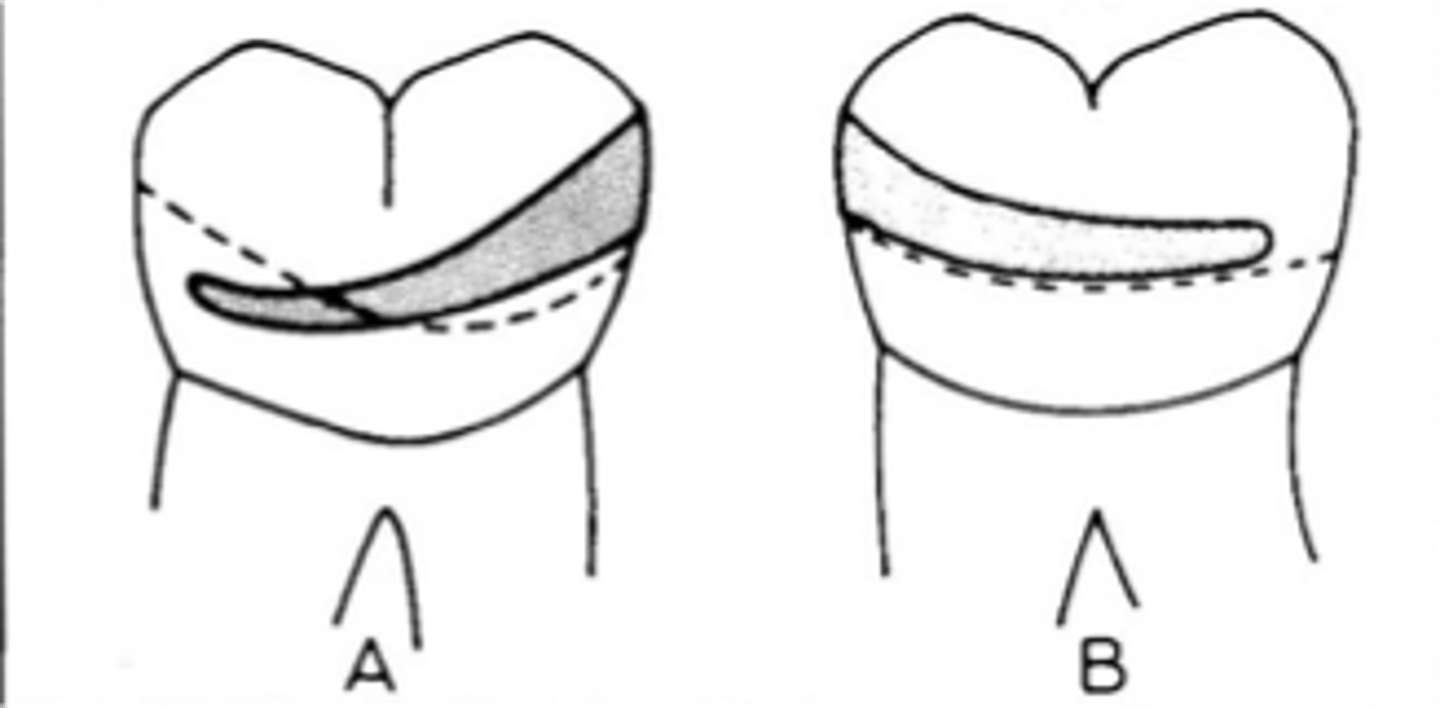 <p>Clasp Assembly six requirements:</p><p>1) Retention: resistance to _______ force. Retentive arm (A) – only terminal 1/3 should be below survey line (height of</p>