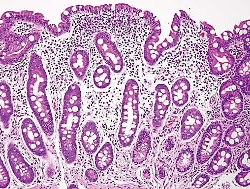 <p>Targets the small intestine via tissue transglutaminase antigen; marked by IgA infiltrates</p>