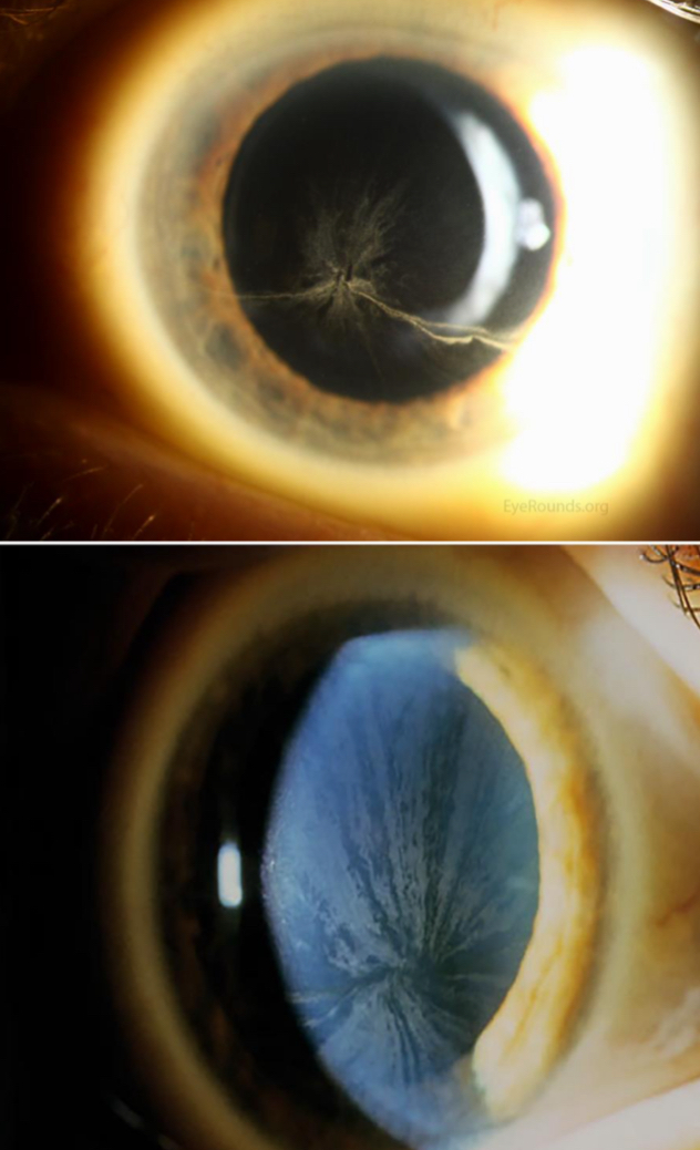 <p>CHAIR-T</p><ul><li><p>chloroquine</p></li><li><p>hydrozychloroquine</p></li><li><p>amiodarone</p></li><li><p>indomethacin</p></li><li><p>rho-kinase inhibitors</p></li><li><p>tamoxifen</p></li></ul><p>*either born with it or it’s systemic (meds)</p>