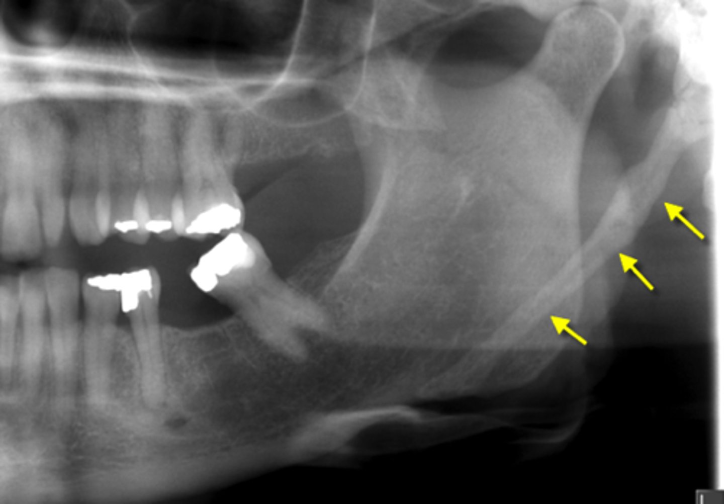 <p>Styloid process</p>