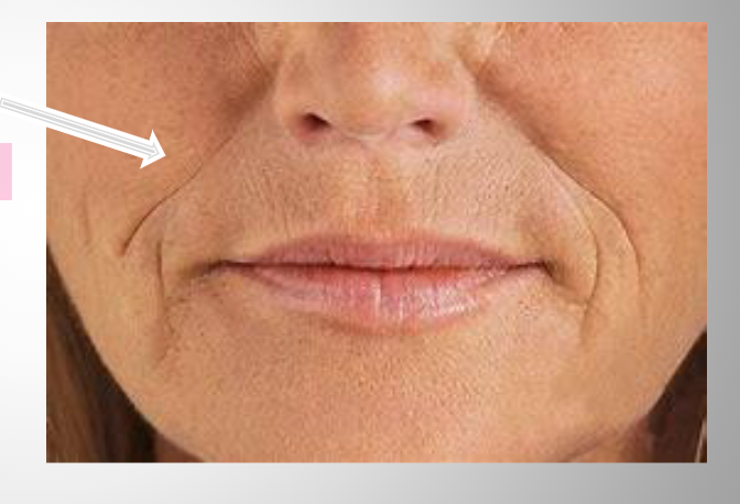 <p><span>Laugh lines</span></p><p><span>Soft tissue "sagging" lines between nose and lips/chin</span></p><p><span>more prominent with age</span></p><p><span>Disappears on facial paralysis</span></p>