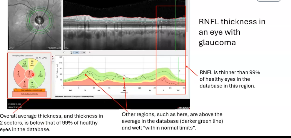 <p>rnfl thickness in an eye with glaucoma</p>