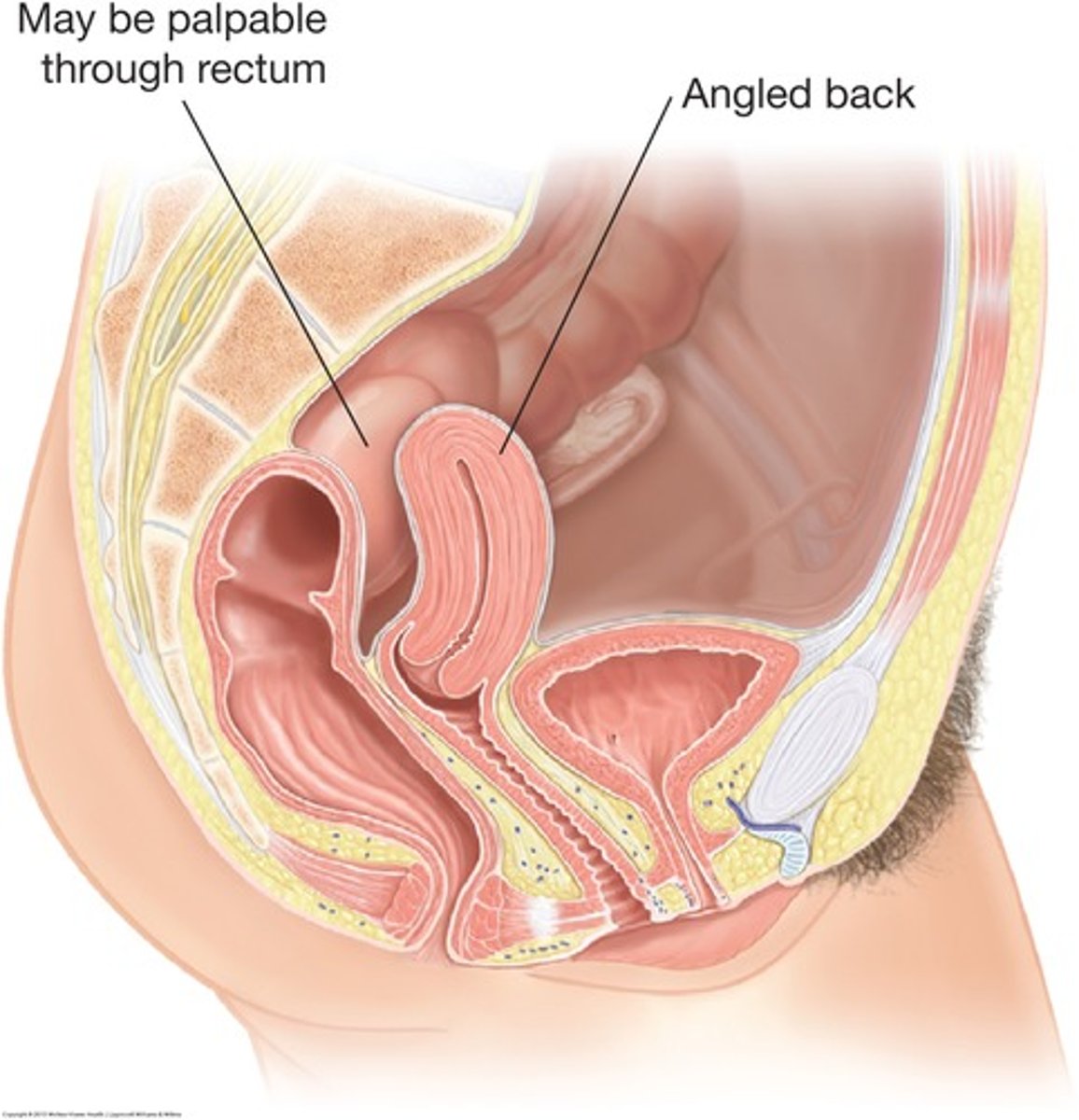 <p>backward angulation of the body of the uterus in relation to the cervix</p>