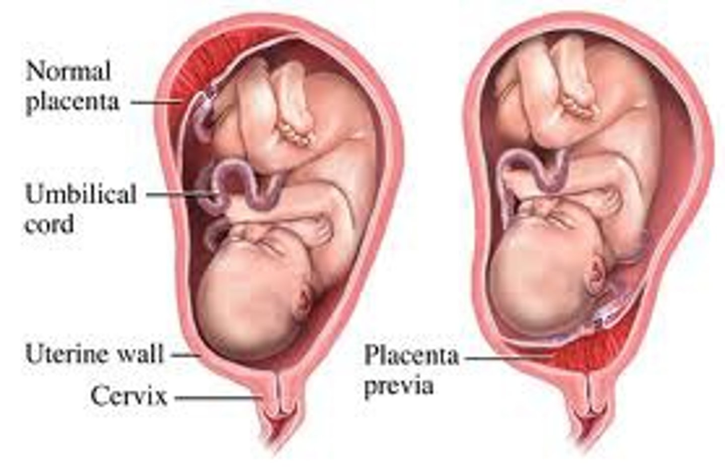 <p>placental tissue over the internal cervical os</p><p>- complications: contraindicates labor, intrapartum or postpartum hemorrhage</p>