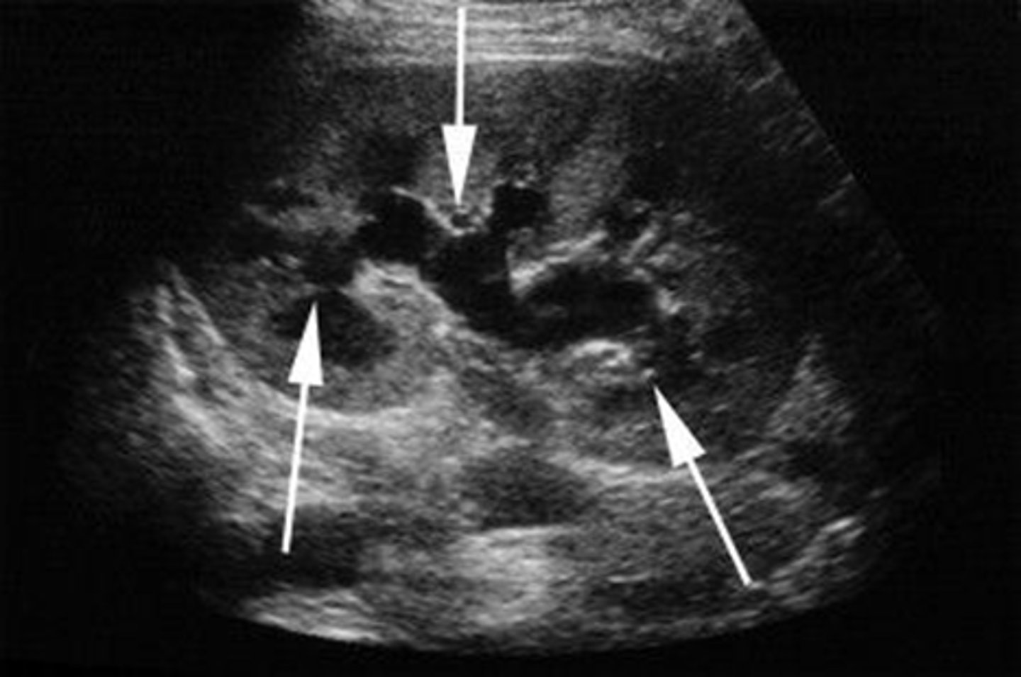 <p>1. Happens at the apex of the kidney, dead tissue</p><p>2. Diabetes, sickle cell anemia, poison</p>