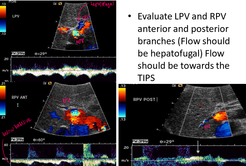 <p>all vessels exhibit hepatofugal flow except the <strong>MPV (hepatopedal or bidirectional)</strong></p>