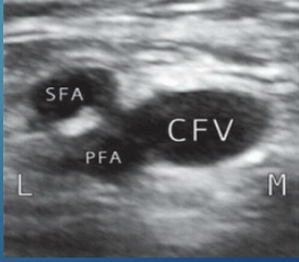 <p>What is site 3 of DVT?</p>