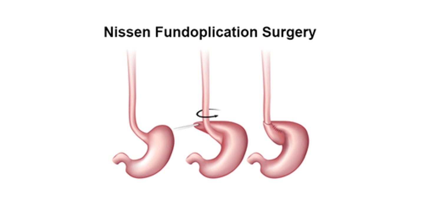 <p>laparoscopic Nissen Fundoplication </p>