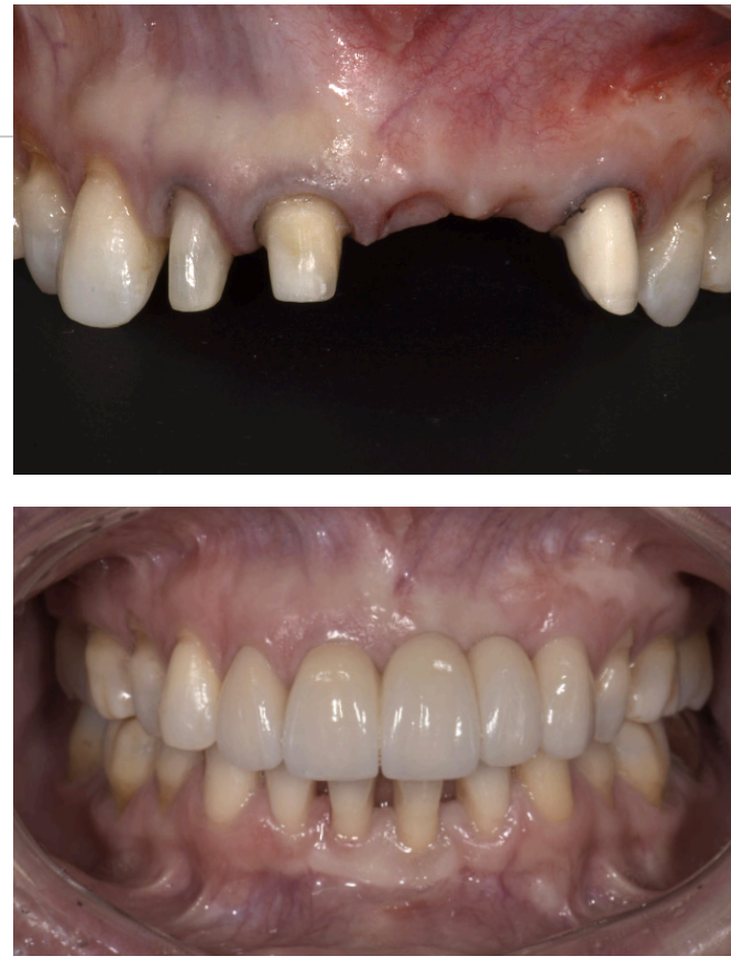 <p>large connector size; diminishes the natural appearance and compromises the ability for oral hygiene maintenance </p>