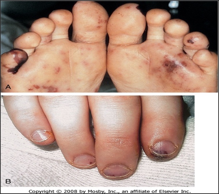 <p>hemorrhagic lesions / petechia seen w/ acute bacterial endocarditis</p>