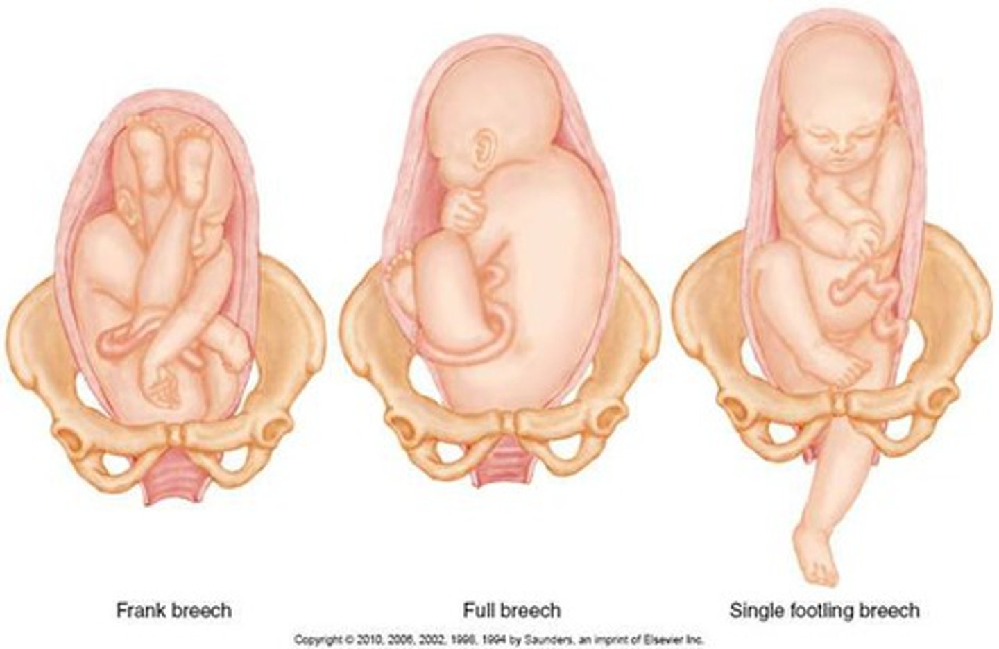 <p>birth position in which the buttocks, feet, or knees emerge first</p>