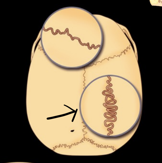 <p>What type of suture</p>