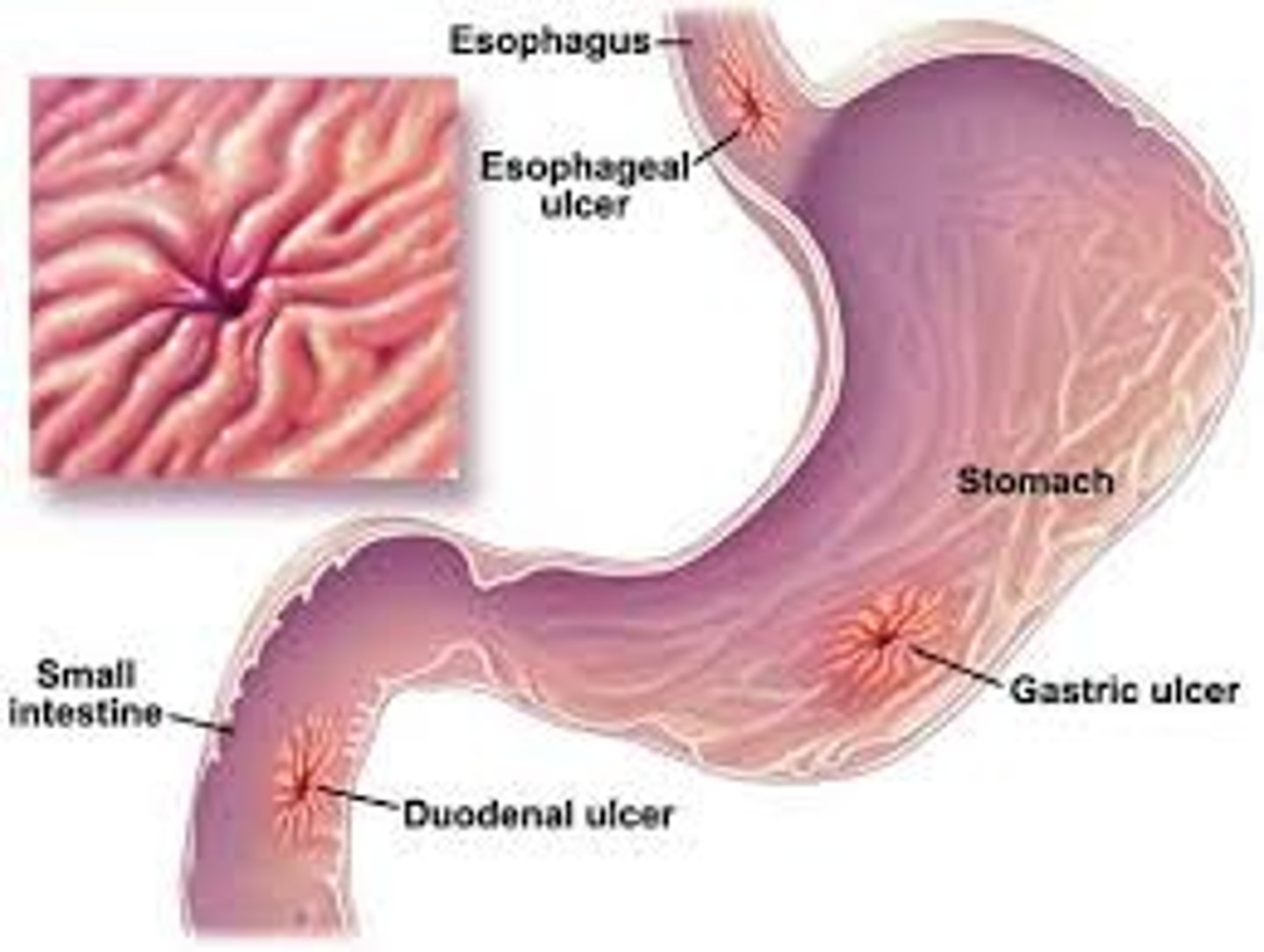 <p>open sores created on the digestive system epithelium, due to inadequate mucus protection --&gt; acid corrosion</p>