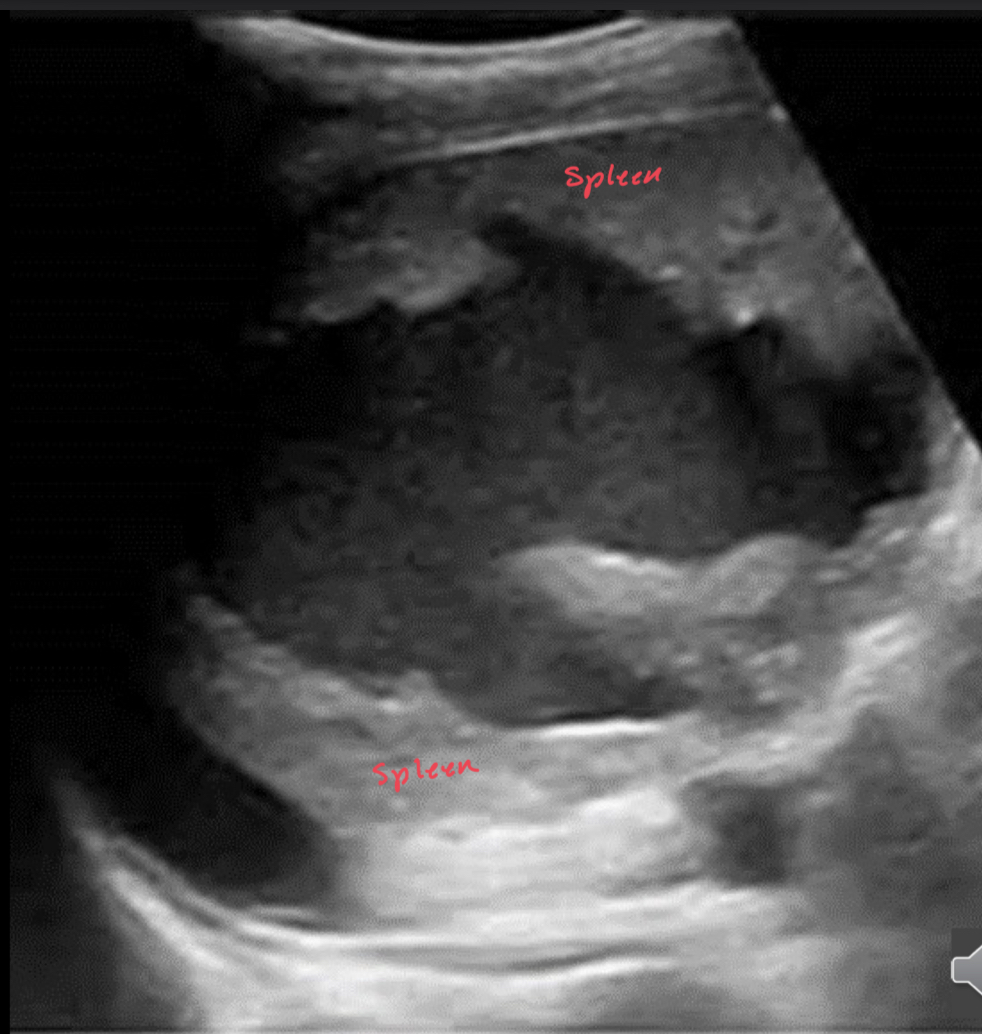 <p>This is a picture of a splenic ______</p>