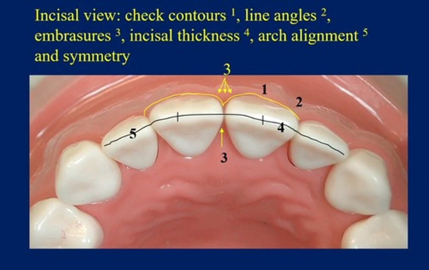 <p>contours, line angles, embrasures, incisal thickness, arch alignment, and symmetry</p>