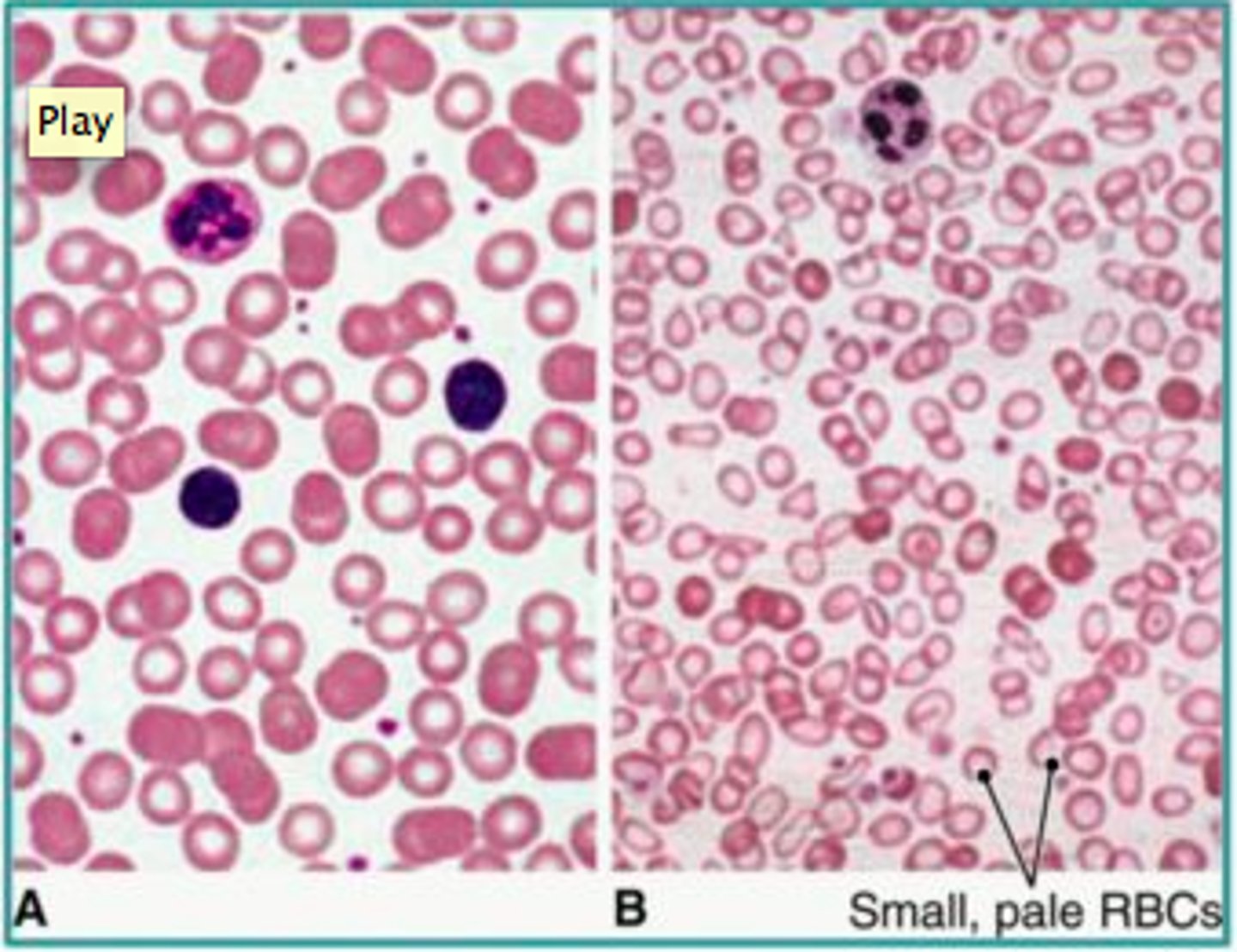 <p>Anemia characterized by small RBCs (caused by iron deficiency)</p>